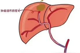 晚期肝癌新选择：持续肝动脉灌注化疗（HAlC）图片
