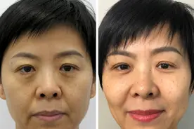 不要轻易做泪沟填充！做完泪沟填充的6个月后，直言坦白几点真相图片