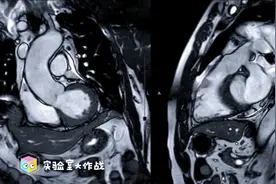 疑似心肌炎的急性和急性后期新冠病毒感染患者的心脏磁共振发现图片