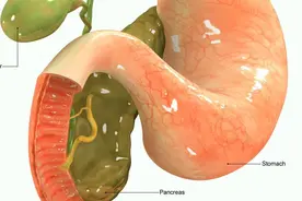 胆囊切除，有啥后遗症？医生坦言：确实有3种，非万不得已，别切图片