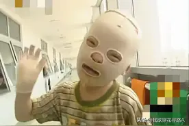 江西一6岁男孩，戴面具生活10余年，如今考上大学成为励志青年！图片
