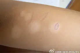 这种白斑，不用治疗也能好图片