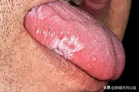 HIV的“刽子手”——机会性感染加速病毒的复制，促进病毒发展图片