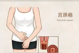宫颈无声的呼救，你注意到了吗？图片