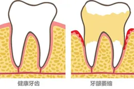 为什么会出现牙龈萎缩？图片