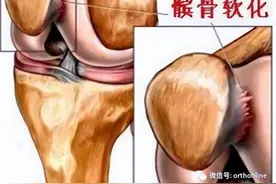收藏 | 髌骨软化症的诊断及治疗策略图片