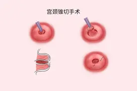 宫颈癌多是拖出来的，身体出现3种异样，可能该做做检查了图片