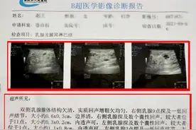 乳腺B超报告单15大名词解读，90%的人不知道！图片