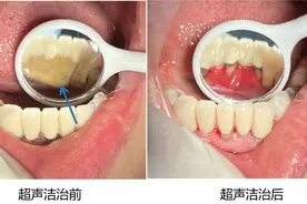 哈医大一院牙周专家谈：“洗牙”之前为什么要验血图片