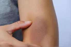 【答个疑】为什么女生腿上总有淤青？图片