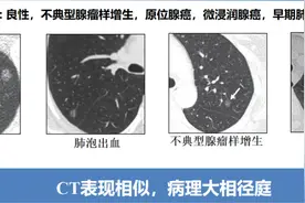 什么样的磨玻璃结节才是肺癌的前兆？图片