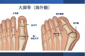 拇外翻里面是怎么样的，拇外翻手术怎么做图片