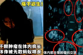 女孩体内密密麻麻上千肿瘤，身体像被蚂蚁啃食，医生看了头皮发麻图片