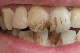 牙齿上的烟渍怎么去除？图片