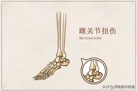 急！崴脚后，先热敷还是先冷敷？一句话教你加速康复！图片