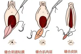 顺产最怕的不是侧切而是撕裂，孕妈妈如何避免？图片