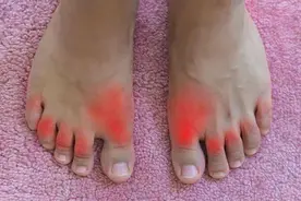 尿酸过高时，身体或有4个症状，了解后，及时控制尿酸水平图片