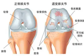 膝盖出现肿胀和疼痛是什么原因引起的？图片