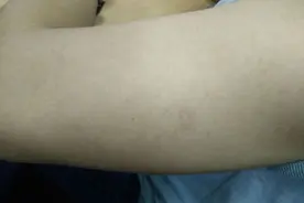 别再错把艾滋病当皮肤病！高危2周后，皮肤3个症状可能是艾滋病！图片