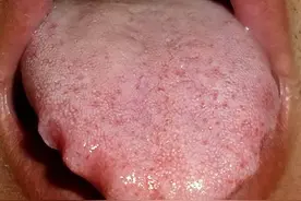 白开水加2味中药，健脾又祛湿，逼走多年齿痕舌！图片
