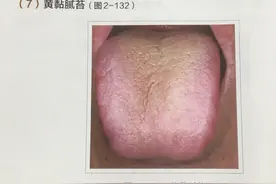 带大家认识一下黄苔，整理了黄苔的舌诊辨证图片