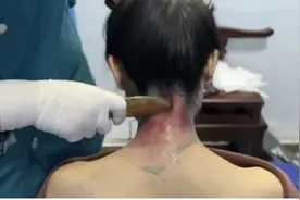 了不起的中医 | 有一种刮痧叫“虎符铜砭”图片