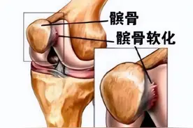 引起膝关节疼痛原因很多，髌骨软化症不可忽视图片