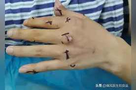 长出痛风石不要紧，手术切除就可以？医生问，您降尿酸了吗？图片