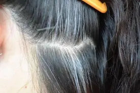 白发长在哪，病就在哪出？长在前额、两鬓、后脑勺，分别代表啥？图片