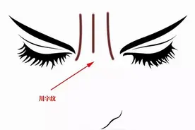 什么是川字纹，该如何消除川字纹？图片