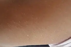 孩子脸上手臂腿部密密麻麻的疙瘩是什么 孩子冬天脸上两侧小疙瘩图片