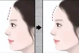 额头凹凸不平，天庭不饱满，如何拥有美丽侧颜？图片