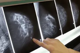 乳房大的女性，更易患乳腺癌？注意：这6类人才是乳腺癌高发人群图片