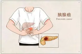 胰腺癌晚期临终老人的症状2图片