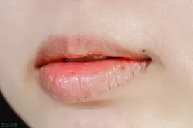 阴虚火旺，用了知柏地黄没效果？李医生教你一招，滋阴去火图片