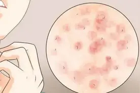 怎样辨别荨麻疹还是湿疹？图片