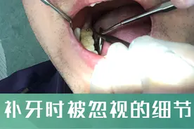 纯知识 | 补牙材料怎么选？补牙时要注意的细节，补牙后注意事项图片