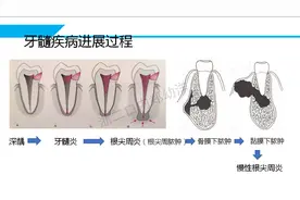 牙龈肿胀、疼痛、脓包，可能根尖周发炎了图片
