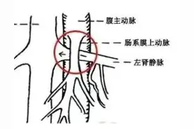 经典影像学表现--“胡桃夹综合征”图片