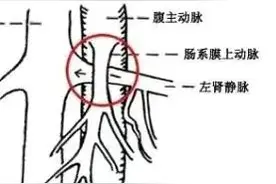 经典影像学表现--“胡桃夹综合征”图片