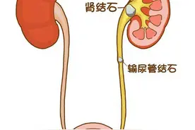 「知识科普」泌尿系结石知多少？图片