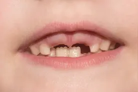 孩子门牙出现锯齿怎么回事？会自行消失吗？图片