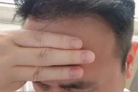 正常发际线是几根手指 正常发际线在哪个位置图片