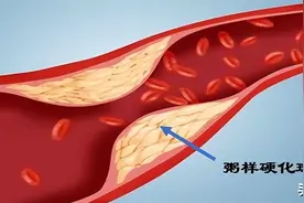 50岁大叔斑块消失，医生：他长期坚持3个护血管方法，行之有效图片