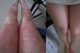 夏季牛皮癣，抓住这个时机！3个专用药帮你消退皮损，不复发。图片
