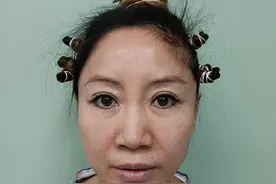 45岁从沈阳专门来北京做拉皮，3个月效果大分享，前后像“两人”图片