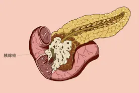 “癌王”胰腺癌，确诊到死亡仅1年！日常有3种表现，是胰腺在求救图片