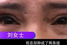 2020年女子自称万人迷，却被整容毁了，两只眼睛一大一小不敢见人图片