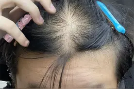 秃顶变爆炸头的绝密方法分享！学会这三招，和尚都能长头发！图片