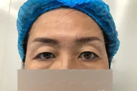 49岁接受不了眼皮松弛下垂，勇敢做了提眉手术，来看术后恢复效果图片